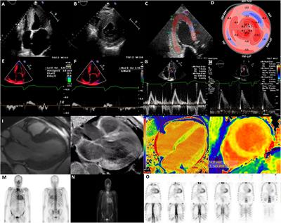 The Role of Multi-modality Imaging in the Diagnosis of Cardiac Amyloidosis: A Focused Update